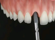 深圳維港牙醫介紹：點解講種植牙手術中種植牙醫生嘅技術更加重要？