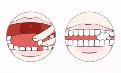 剛換的牙因外傷脫位怎麼辦？