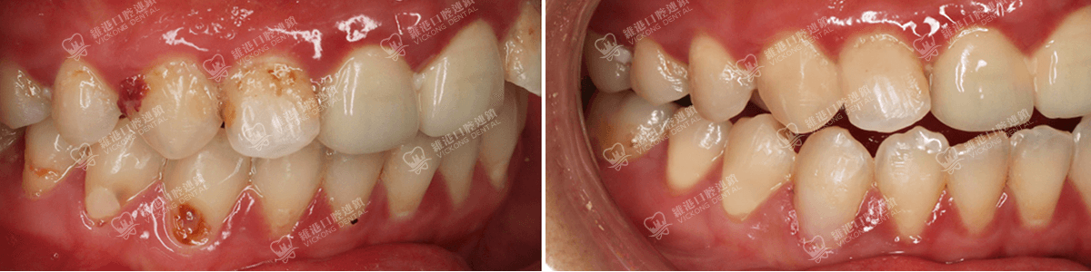 深圳種牙&深圳維港口腔