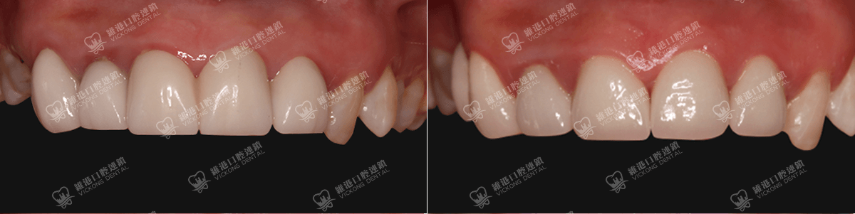 深圳種牙&深圳維港口腔