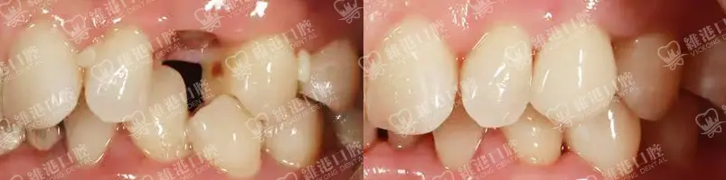 深圳種牙&深圳維港口腔