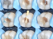 落馬洲口岸牙科維港口腔科普：補牙前點解牙醫要磨一個大洞？