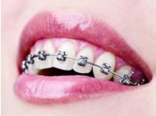 深圳箍牙分為幾個階段？箍牙有哪幾種類型？