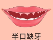 半口缺牙點算好？上深圳咁樣種牙即省一半費用！