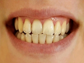牙齒爲什麽會發黃？牙齒發黃會遺傳嗎？