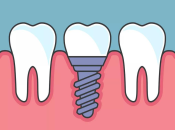 上深圳種牙嘅牙齒通常可以用幾耐？如果種植牙壞咗點算？