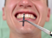 種植牙骨增量、即刻負重係咩意思？深圳複雜牙齒種牙推介！