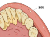深圳牙周治療：牙周炎嘅基礎治療程序