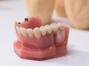 上深圳睇牙，牙醫推薦我做牙橋或者植牙，請問二者有什麼區別？