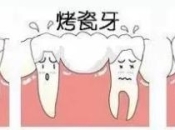 牙爛咗只剩牙根點算？深圳種牙貴嗎？