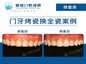 深圳烤瓷牙套更換全瓷牙套幾錢？