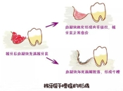 深圳拔牙——什麼是幹槽症呢？怎麼治療呢？