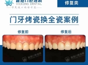 深圳烤瓷牙套更換全瓷牙套幾錢？