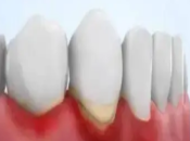 深圳牙周治療——慢性牙齦炎怎麼治療呢？