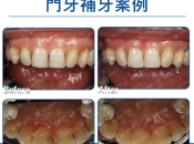 深圳維港口腔補門牙效果點樣？幾錢？廣東話話你知！