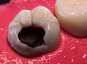 智慧齒點解容易蛀牙咧？羅湖脫智慧齒有冇discount？