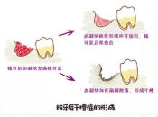深圳拔牙——什麼是幹槽症呢？怎麼治療呢？