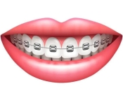 深圳箍牙點解要按時覆診？維港口腔箍牙收費標準