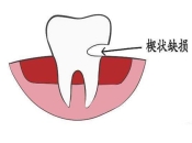 在深圳楔狀缺損如何修復？