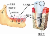 深圳種植牙報價4800元可靠嗎？