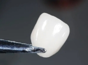 牙貼片會唔會容易脫落？珠海牙貼片邊度好？收費價錢係幾多？