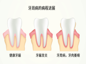 牙周治療點解價錢唔同，深圳牙科牙周治療點收費？ 
