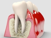 刷牙出血牙齒唔痛，究竟係咩原因導致嘅咧？深圳牙科哪家好？