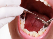 深圳維港口腔牙醫解答：導致齲齒蛀牙嘅原因有邊啲？