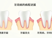 牙周治療點解價錢唔同，深圳牙科牙周治療點收費？ 
