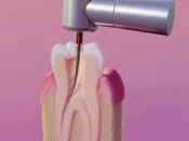 杜牙根有咩作用，維港口腔杜牙根後要注意咩？