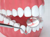 牙周病要點樣預防咧？維港口腔牙周治療收費？