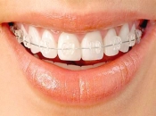 大陸箍牙可以只箍一排嗎？箍牙有哪些優缺點？