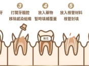 落馬洲口岸牙科維港口腔科普：蛀牙嚴重到底杜牙根好抑或直接剝牙咧？