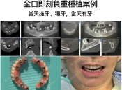 維港口腔微創植牙流程點樣？要幾耐？幾錢？