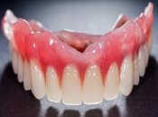 影響全口活動假牙固定嘅因素有咩咧？大陸全口活動假牙幾錢？