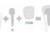 深圳牙醫杜牙根之後話做牙套比較好，真定假？仲需要打樁？