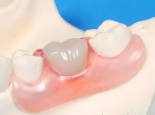 牙周病缺牙整邊種假牙好？大陸假牙價錢？