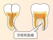 經常牙痛牙齒可能裂咗！牙裂要杜牙根嗎？深圳杜牙根價錢？