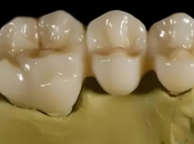 唔合格嘅假牙套竟然會引發口臭？深圳假牙套介紹