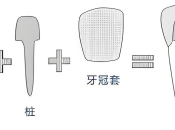 嗰啲杜牙根後冇做牙套嘅牙齒，宜家變成點？深圳杜牙根牙套套餐優惠價！