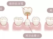 港人深圳牙科睇牙，點選擇平靚嘅牙冠？