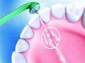 深圳洗牙—洗牙中經常遇到嘅問題