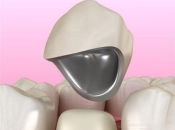 港人北上深圳鑲牙點揀好？拆解烤瓷牙常見問題與全瓷牙選擇指南