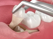 深圳拔牙後幾時可以刷牙？深圳拔智慧齒價錢？