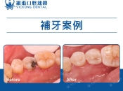 深圳羅湖補牙貴嗎？補牙點解要磨咁多再補？
