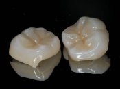 做牙套之後牙痛點算？維港口腔杜牙根幾錢？