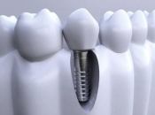 深圳牙醫科普：種植牙會唔會傷害牙神經？可以點樣避免？ 
