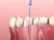 蛀牙到邊種情況就要杜牙根咧？福田杜牙根加瓷牙套幾錢？
