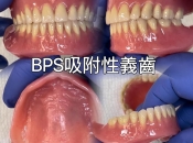 吸附性義齒可以解決咩牙齒問題咧？維港口腔整吸附性假牙有冇優惠？