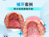 深圳補牙邊家方便價格又划算？銀粉補牙可以換成樹脂補牙嗎？